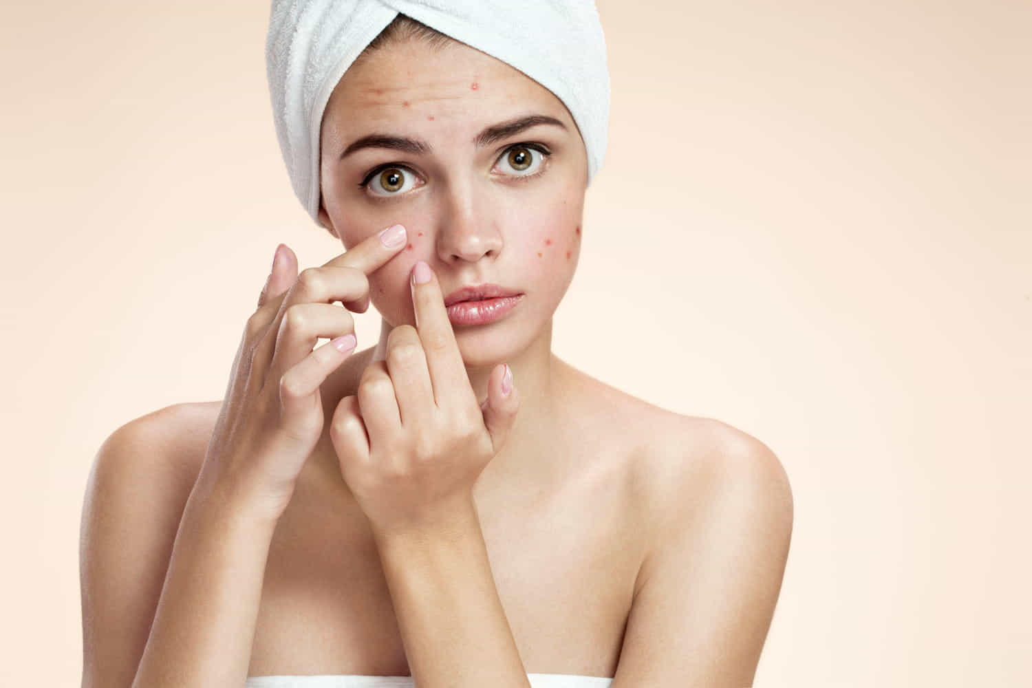 come eliminare l'acne