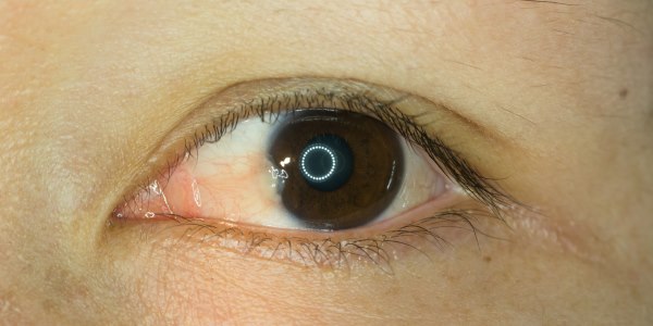 tumore orbita oculare
