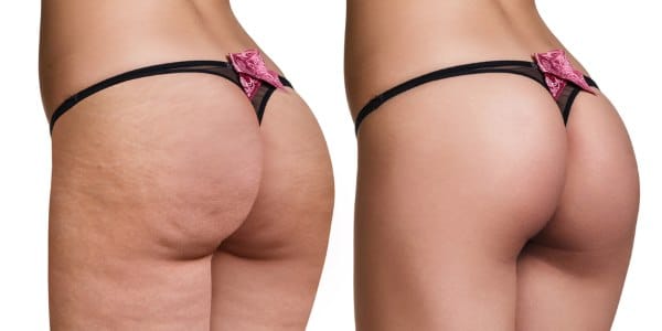 cellulite alimenti giusti