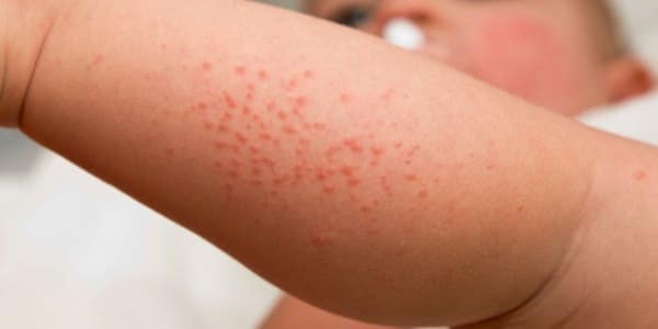Dermatite atopica: aiutare i piccoli malati attraverso il gioco
