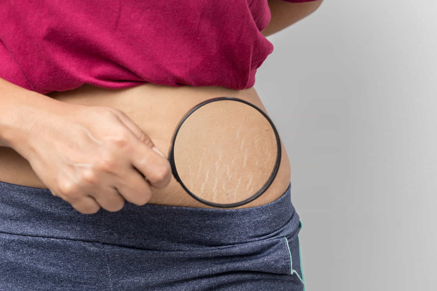 smagliature laser frazionale non ablativo