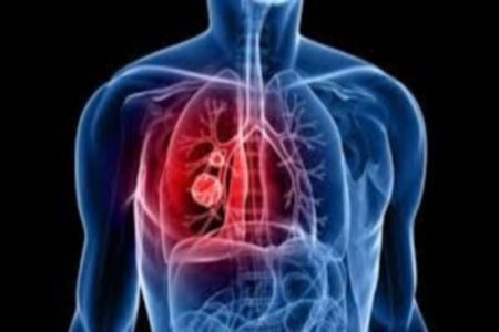 tumore al polmone