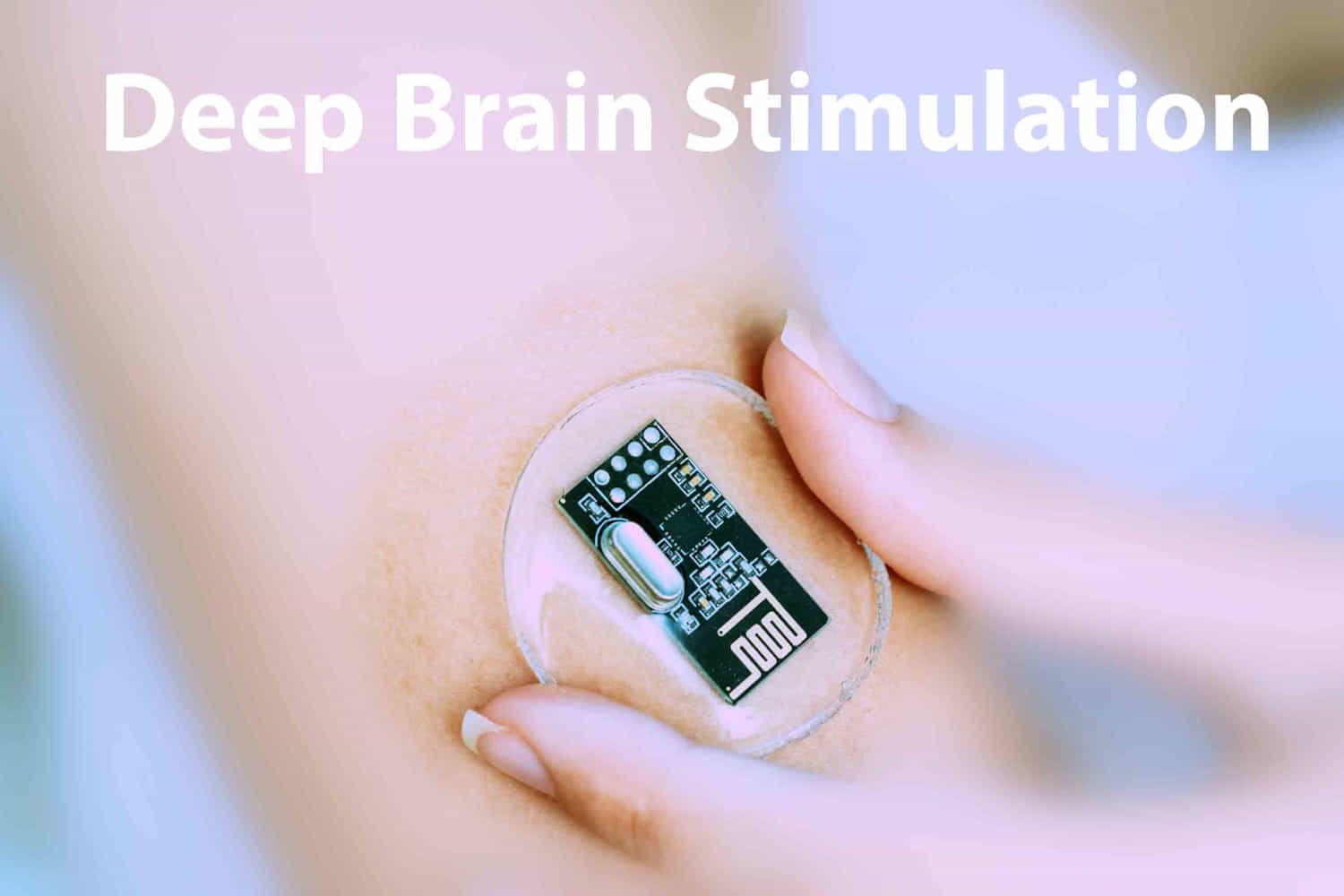 stimolazione cerebrale profonda depressione