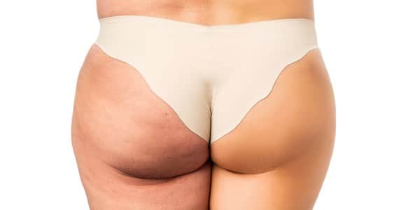 cellulite dieta drastica