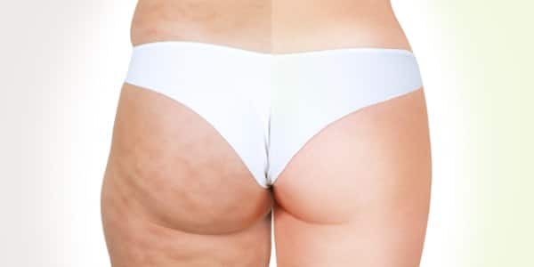 cellulite causa tessuto adiposo alimento deacidificante