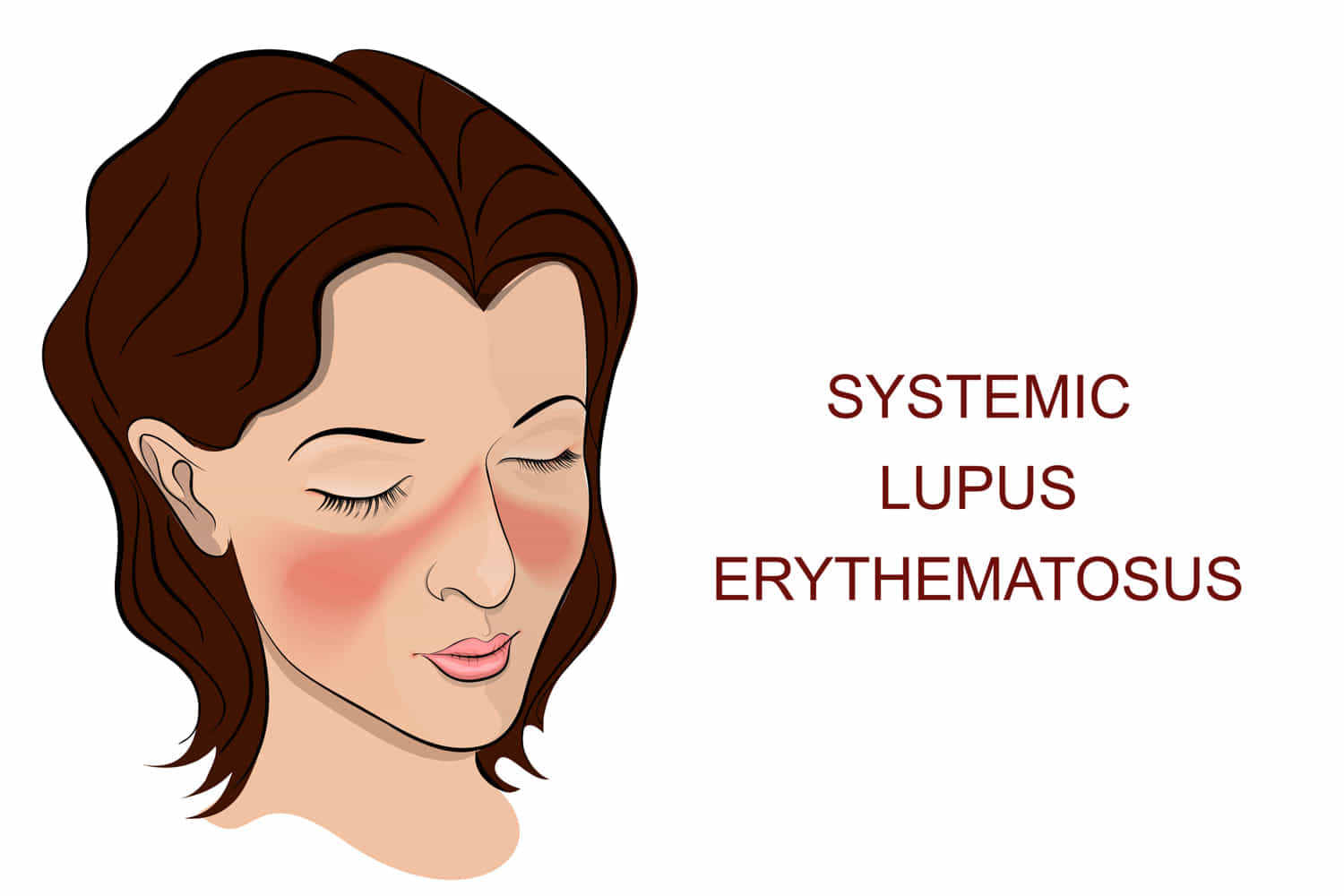 eritematoso sistemico