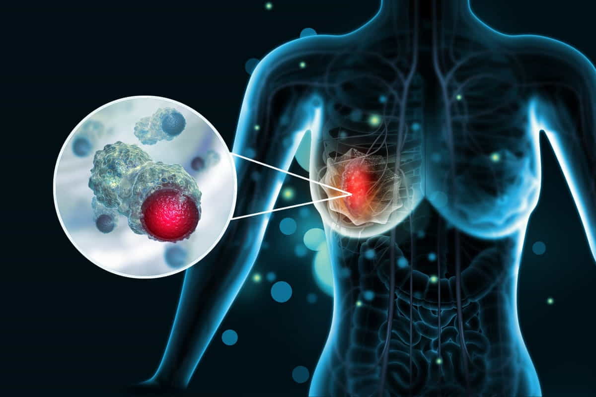 tumore al seno e chemioterapia