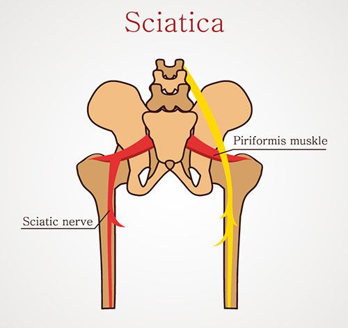 lombosciatalgia sciatica