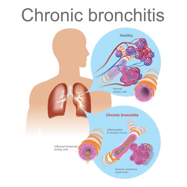 bronchite cronica 2