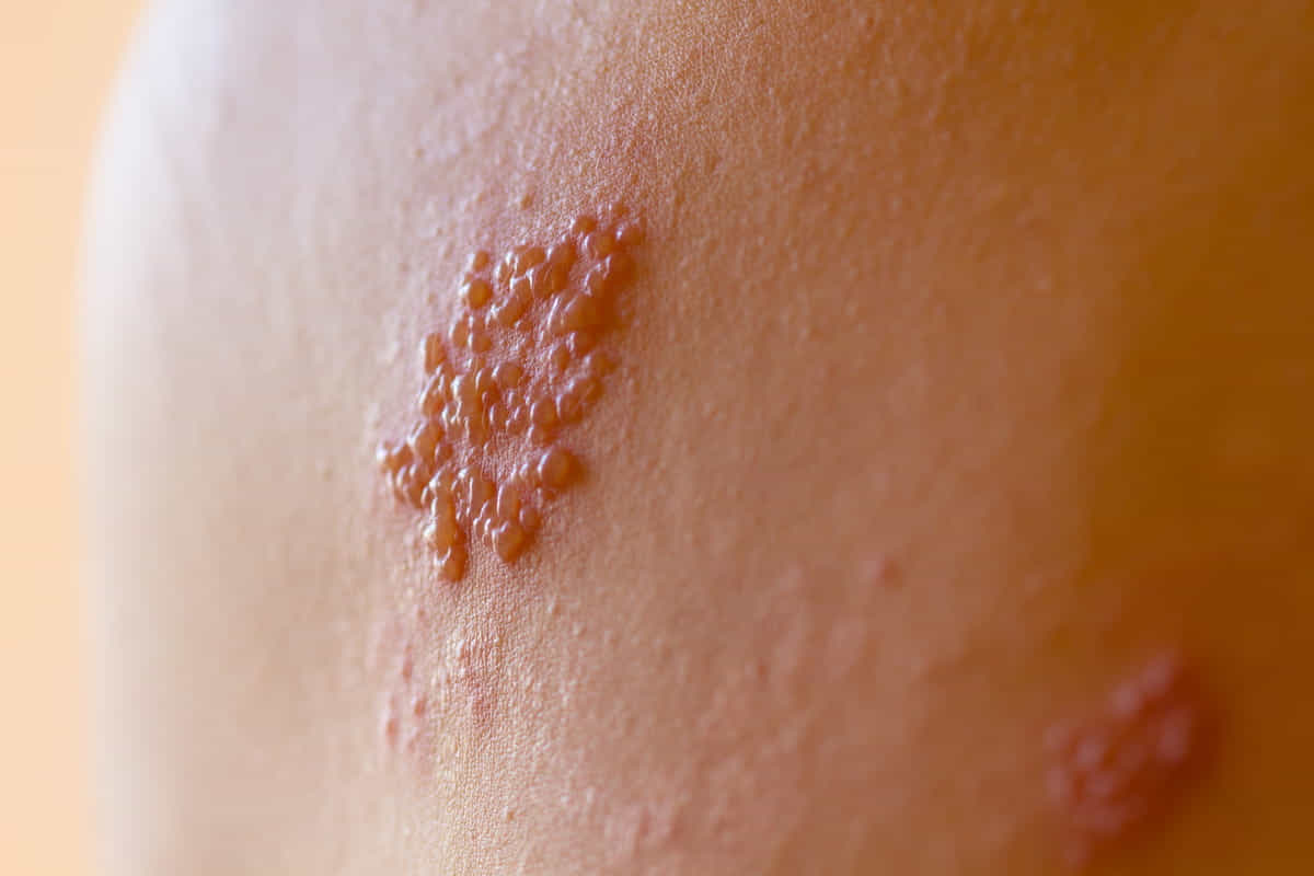 immagine herpes zooster