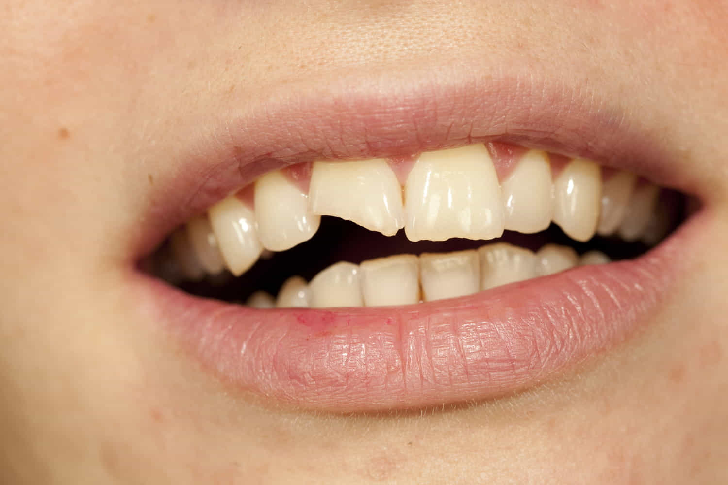 sognare di rompersi un dente