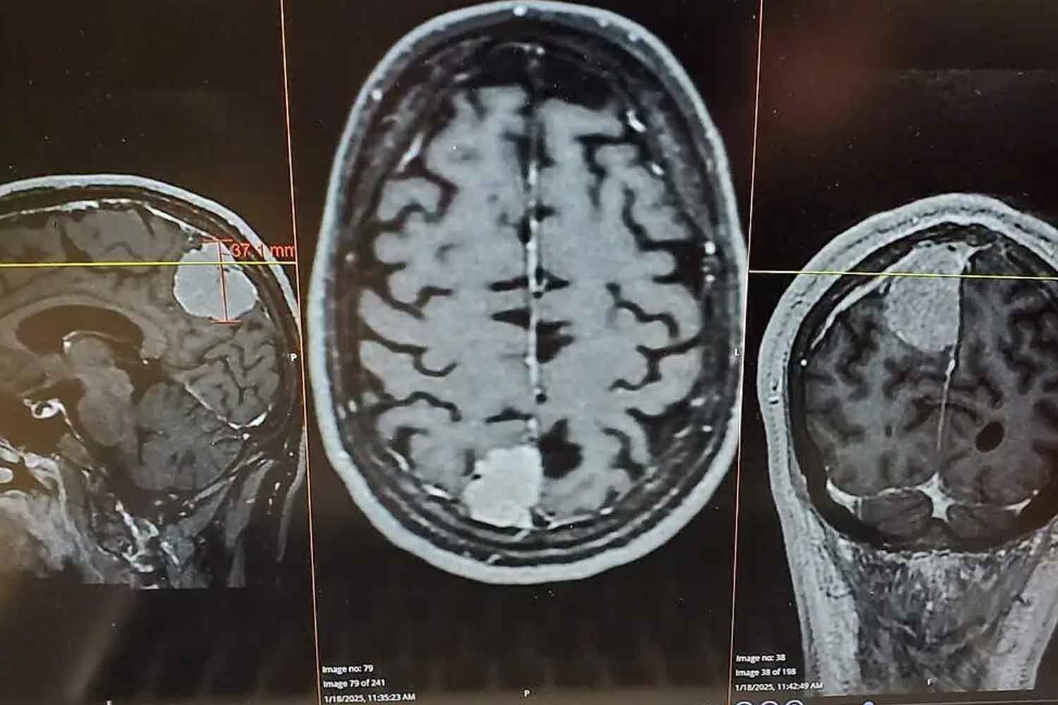 scansione cancro al cervello