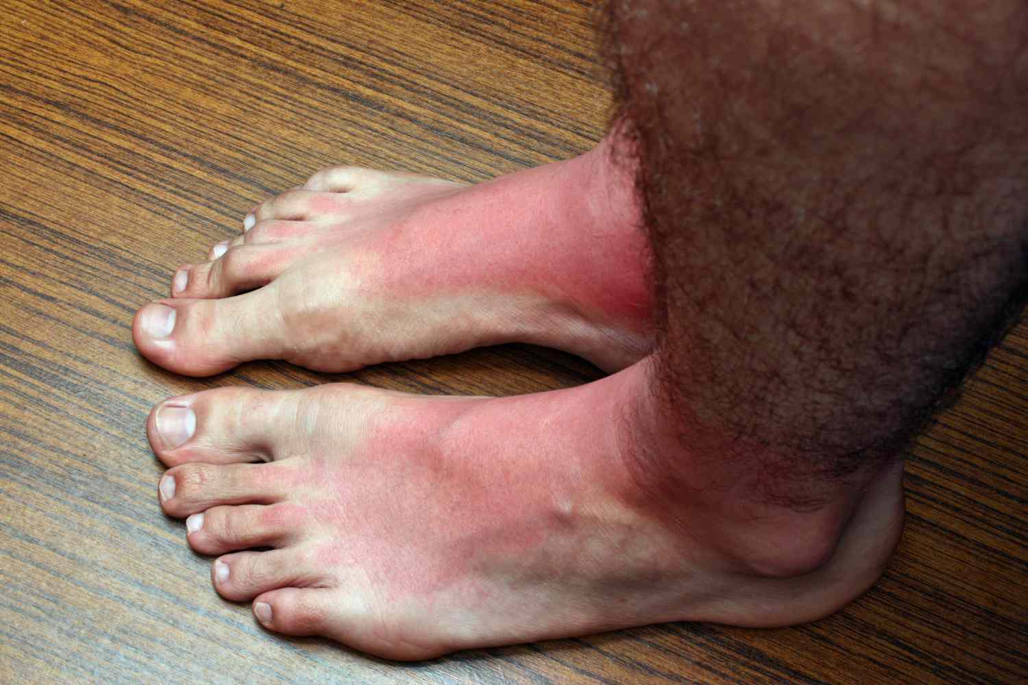 scottature piedi