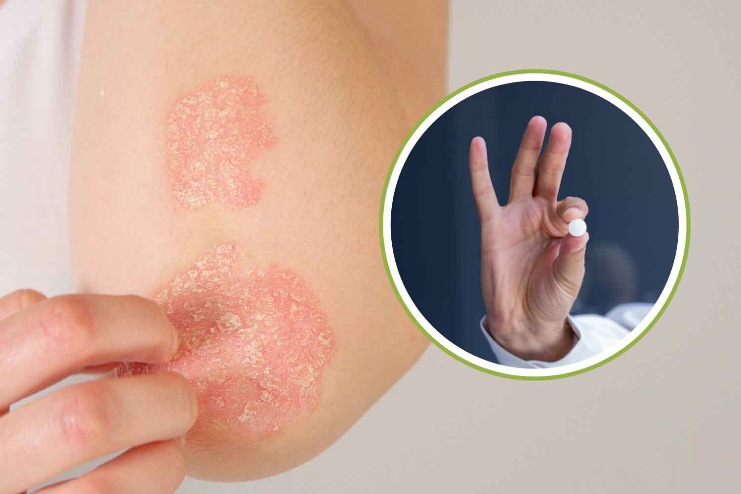 psoriasi pillola