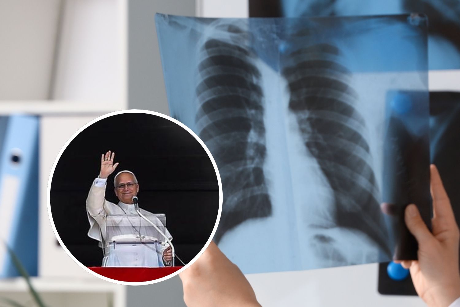 nodulo polmone Papa